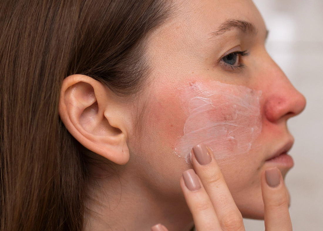 Signs That Your Skin Barrier May Be Damaged