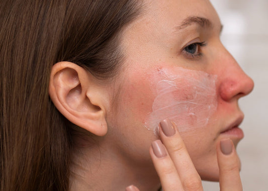 Signs That Your Skin Barrier May Be Damaged
