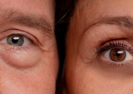 What Ingredients Help with Eye Bags and Puffiness?